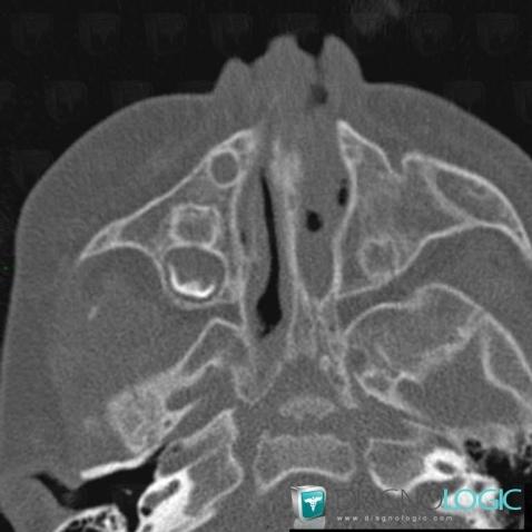 Choanal atresia , Nasal cavity / Nasopharynx, CT