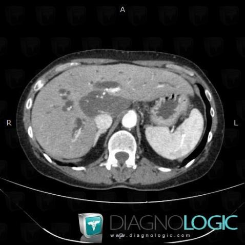 Cholangiocarcinoma, Intra and extra hepatic bile ducts, CT