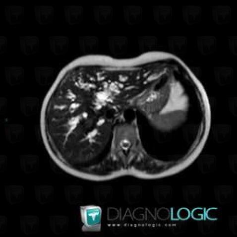 Cholangiocarcinoma, Intra and extra hepatic bile ducts, MRI