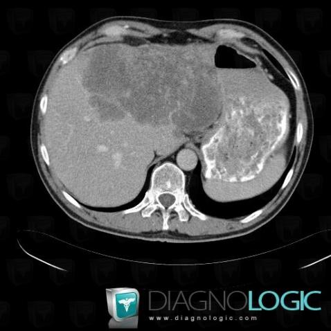 Cholangiocarcinoma, Liver, CT