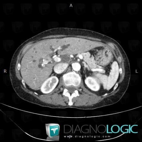 Cholangiocarcinoma, Liver, Intra and extra hepatic bile ducts, CT