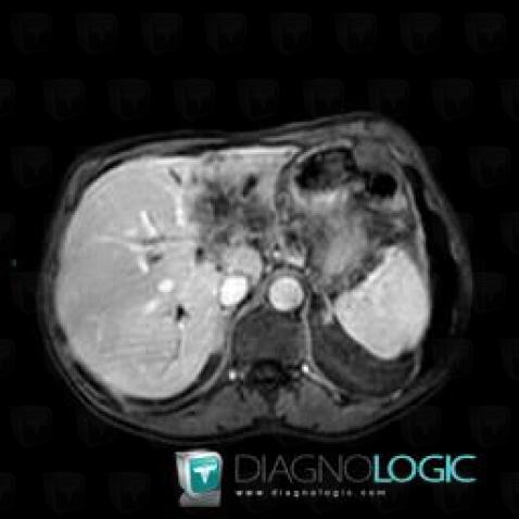 Cholangiocarcinoma, Liver, MRI