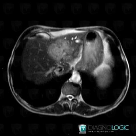 Cholangiocarcinoma, Liver, MRI