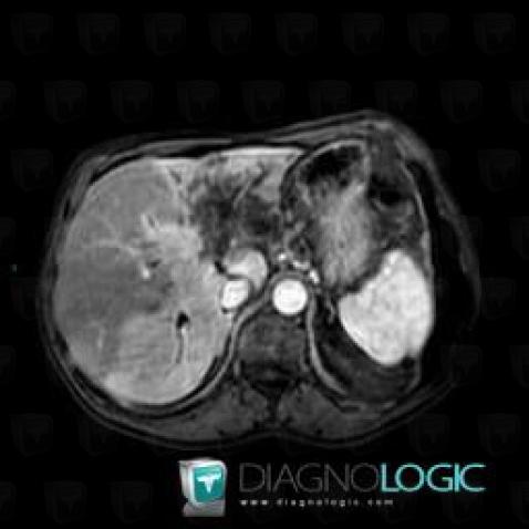 Cholangiocarcinoma, Liver, MRI