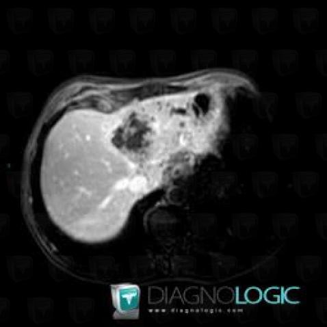 Cholangiocarcinoma, Liver, MRI