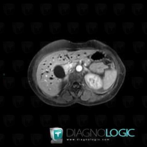 Cholangiocarcinoma, Liver, MRI