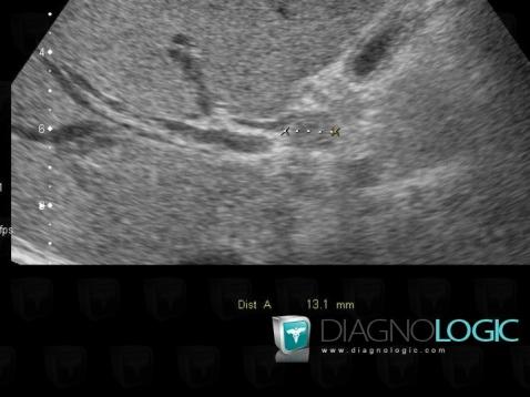 Cholangiocarcinome, Foie, Echographie