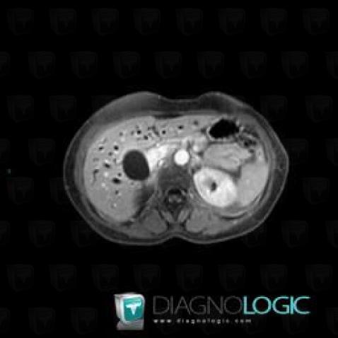 Cholangiocarcinome, Foie, IRM