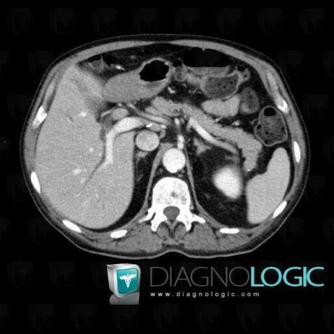 Cholangiocarcinome, Foie, Scanner