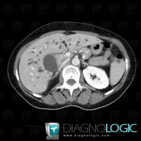 Cholangiocarcinome, Foie, Scanner