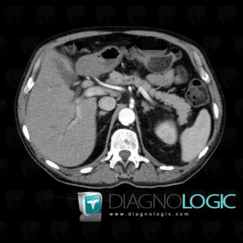 Cholangiocarcinome, Foie, Voies biliaires intra et extra hepatiques, Scanner