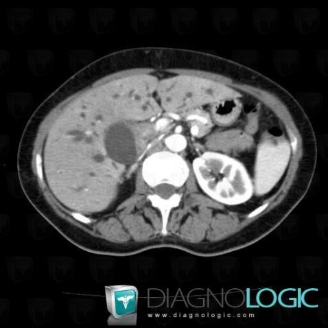 Cholangiocarcinome, Voies biliaires intra et extra hepatiques, Scanner