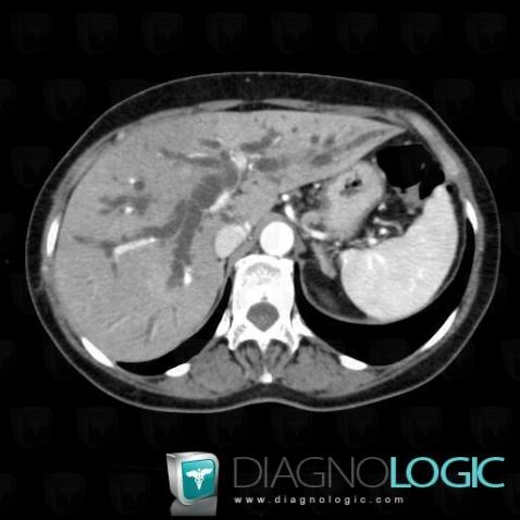 Cholangiocarcinome, Voies biliaires intra et extra hepatiques, Scanner