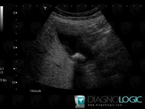 Cholécystite aiguë, Vésicule biliaire, Echographie