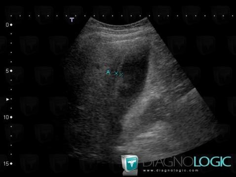 Cholécystite aiguë, Vésicule biliaire, Echographie