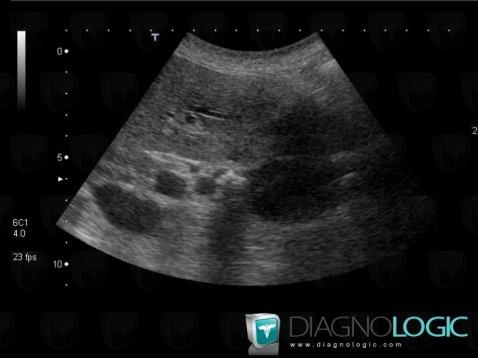 Cholécystite chronique , Vésicule biliaire, Echographie