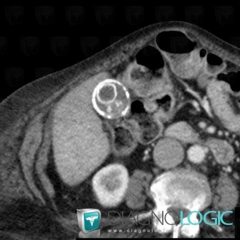 Cholécystite chronique , Vésicule biliaire, Scanner