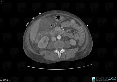 Cholecystitis, Gallbladder, CT