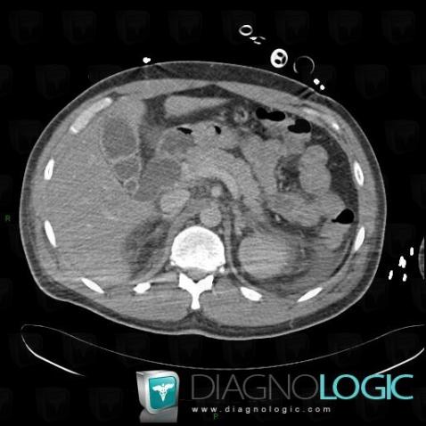 Choledochal cyst, Intra and extra hepatic bile ducts, CT