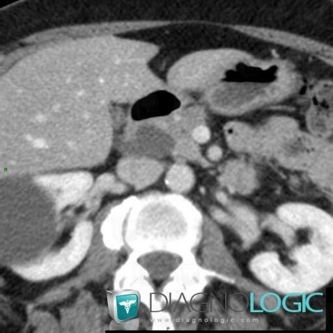 Choledochal cyst, Intra and extra hepatic bile ducts, CT