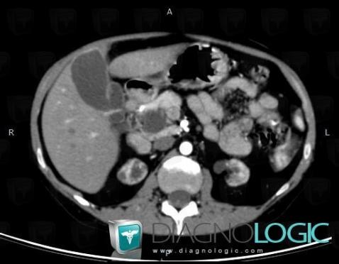 Choledochal cyst, Intra and extra hepatic bile ducts, CT