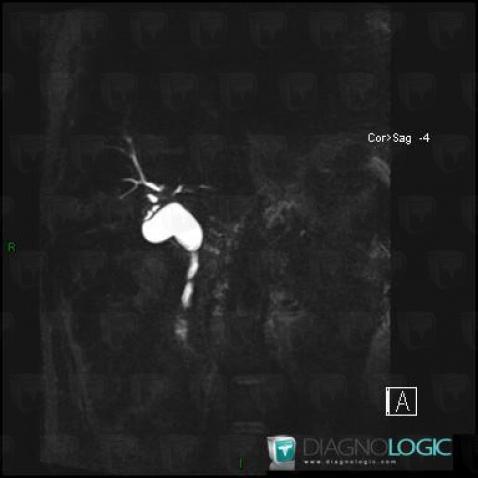 Choledochal cyst, Intra and extra hepatic bile ducts, MRI