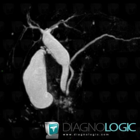 Choledochal cyst, Intra and extra hepatic bile ducts, MRI