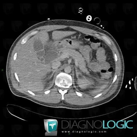 Choledochal cyst, Liver, CT