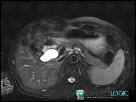 Choledochal cyst, Liver, MRI