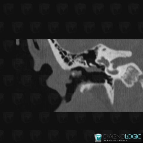 Cholesteatoma, Middle ear, CT