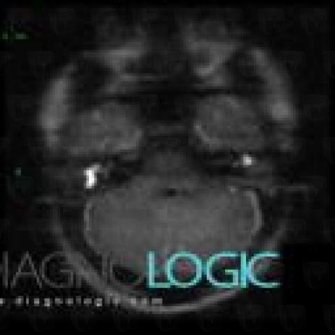 Cholesteatoma, Middle ear, MRI