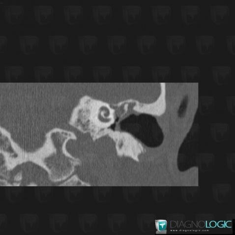 Radiology case : Cholesteatoma (CT) - Diagnologic