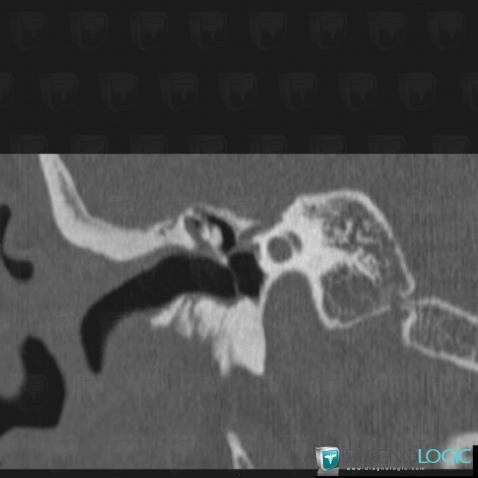 Cholesteatoma, Temporal bone, Middle ear, CT