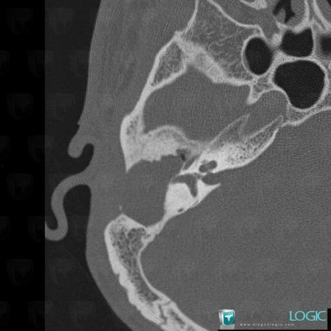 Cholesteatoma, Temporal bone, Middle ear, CT