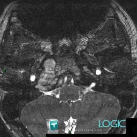 Cholesteatoma, Temporal bone, MRI