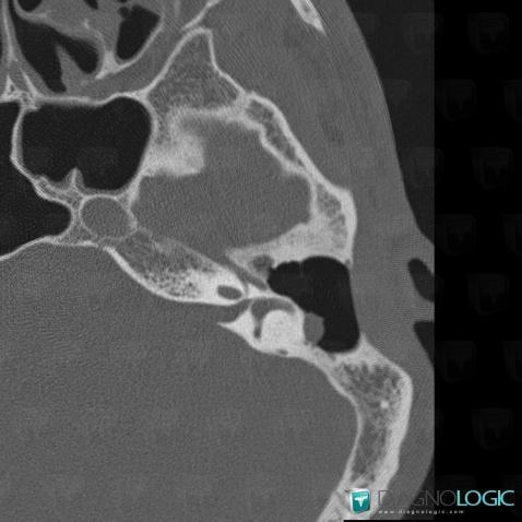 Cholestéatome , Oreille moyenne, Scanner