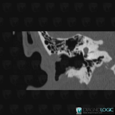 Cholestéatome , Os temporal, Oreille externe, Scanner