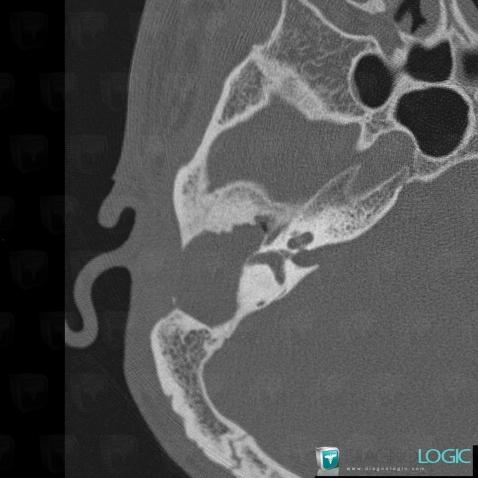 Cholestéatome , Os temporal, Oreille moyenne, Scanner