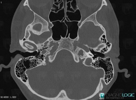 Cholesterol granuloma, Temporal bone, CT