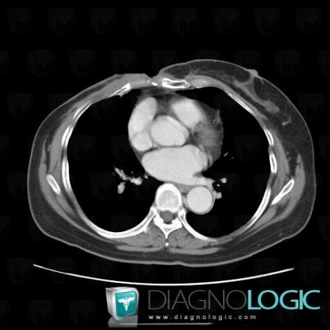 Chondrite, Articulation Costo-sternale / Sterno-claviculaire et Cartilage chondrocostal, Scanner