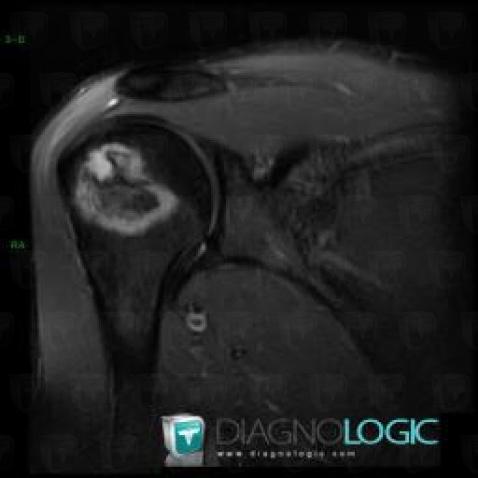 Chondroblastome, Humérus -supérieur, IRM