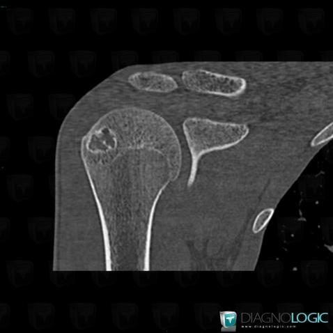 Cas radiologie : Chondroblastome (Scanner) - Diagnologic