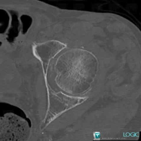 Chondrocalcinose articulaire, Articulation coxo fémorale, Scanner