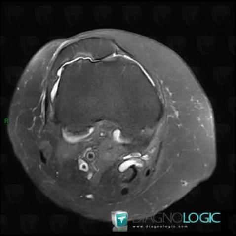 Chondrocalcinose articulaire, Articulation fémoro patellaire, IRM