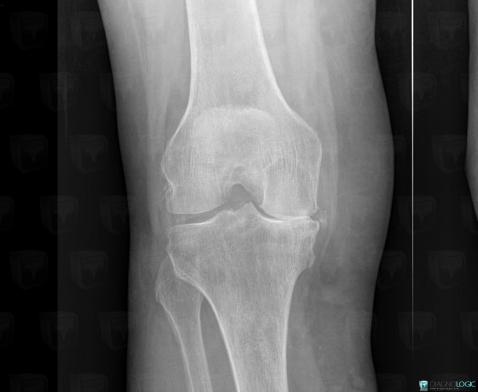 Chondrocalcinose articulaire, Articulation fémoro patellaire, Radio