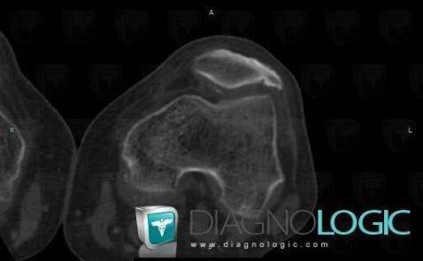 Chondrocalcinose articulaire, Articulation fémoro patellaire, Scanner