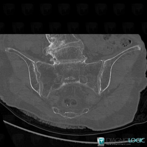 Cas radiologie : Chondrocalcinose articulaire (Scanner) - Diagnologic