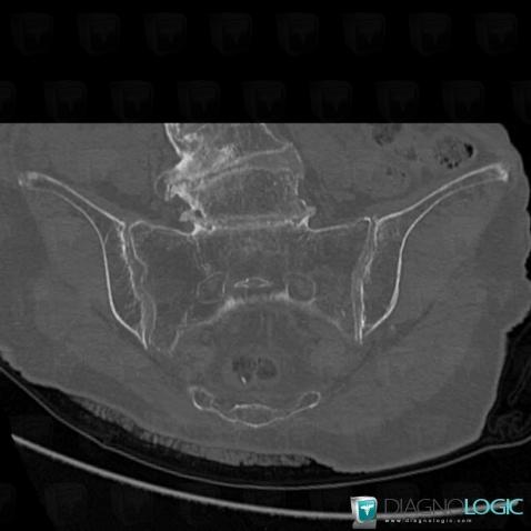 Chondrocalcinose articulaire, Articulation sacro iliaque, Scanner