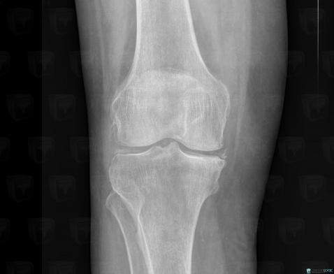 Chondrocalcinose articulaire, Articulations fémoro tibiales / Echancrure, Radio