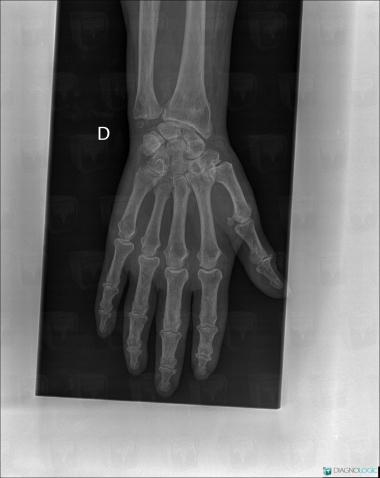 Chondrocalcinose articulaire, Autres parties molles/nerfs - Poignet, Radio